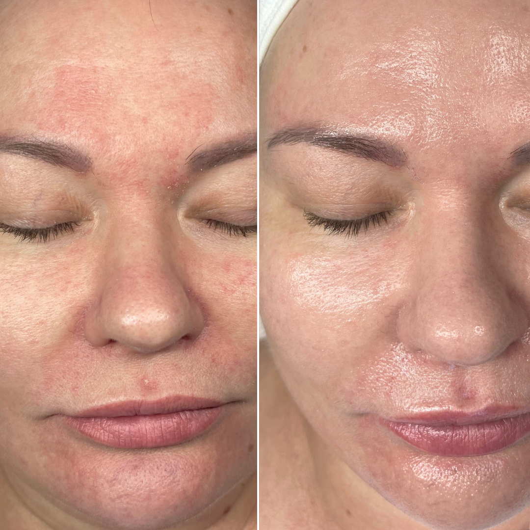 After skin transformation