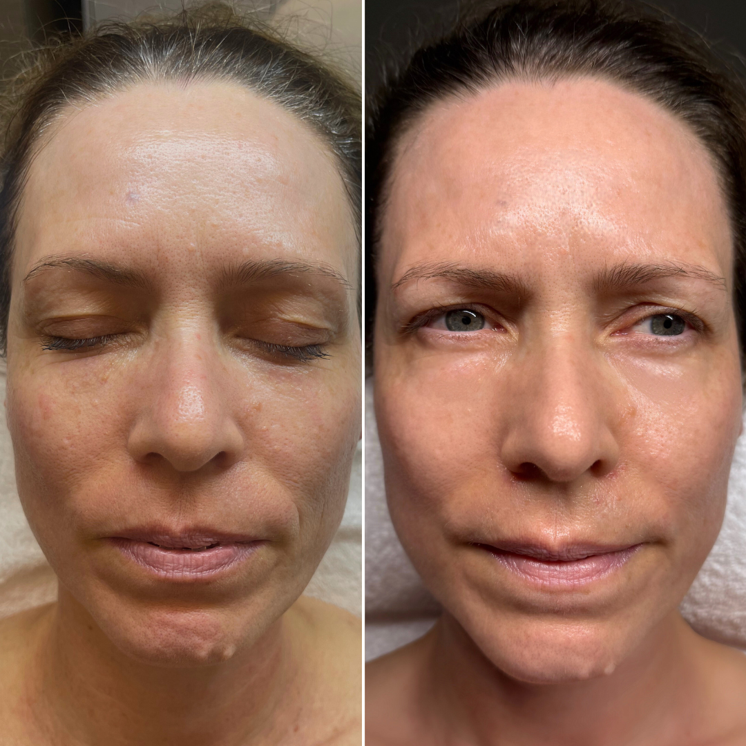 Before skin transformation