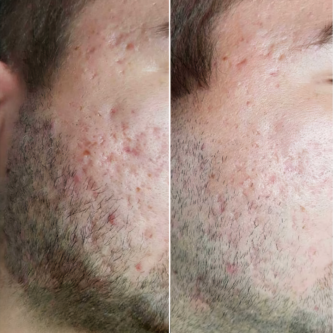 After skin transformation