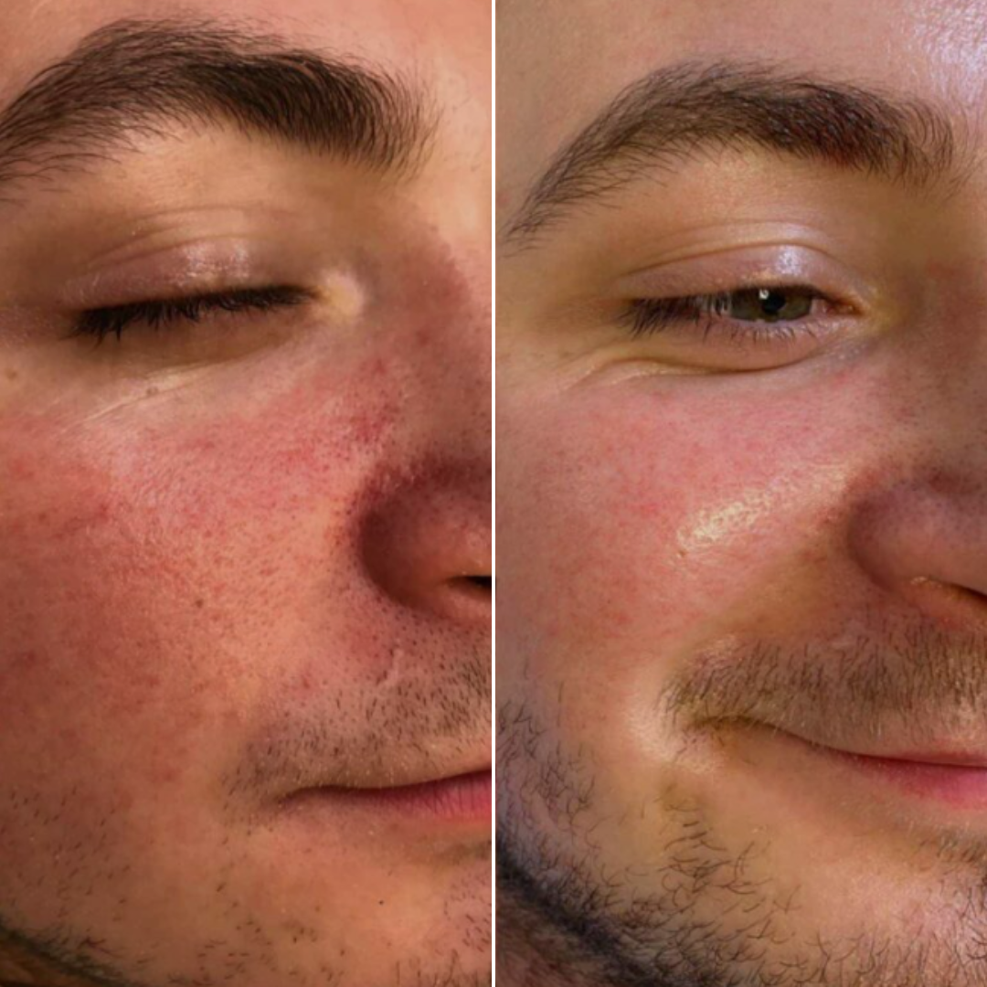 After skin transformation