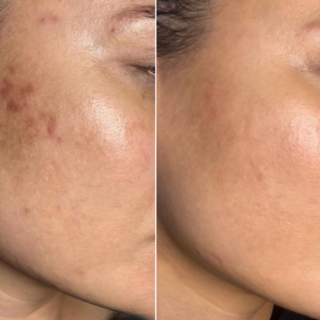After skin transformation